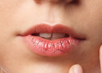 labios resecos