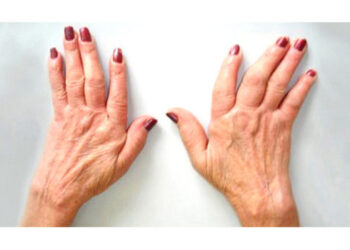 Todo lo que necesita saber sobre la osteoartritis: signos, síntomas y tratamientos