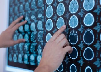 Terapia con células madre: ¿La solución para tratar el Alzheimer?