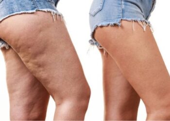 Lipedema, tratamientos