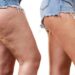 Lipedema, tratamientos