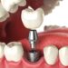 implante dental