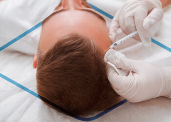 Impacto psicológico de la alopecia: Cómo afrontar la pérdida de cabello