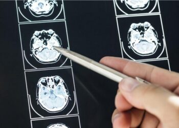 TBI: Causas Comunes, Síntomas, Efectos y Opciones Legales Disponibles